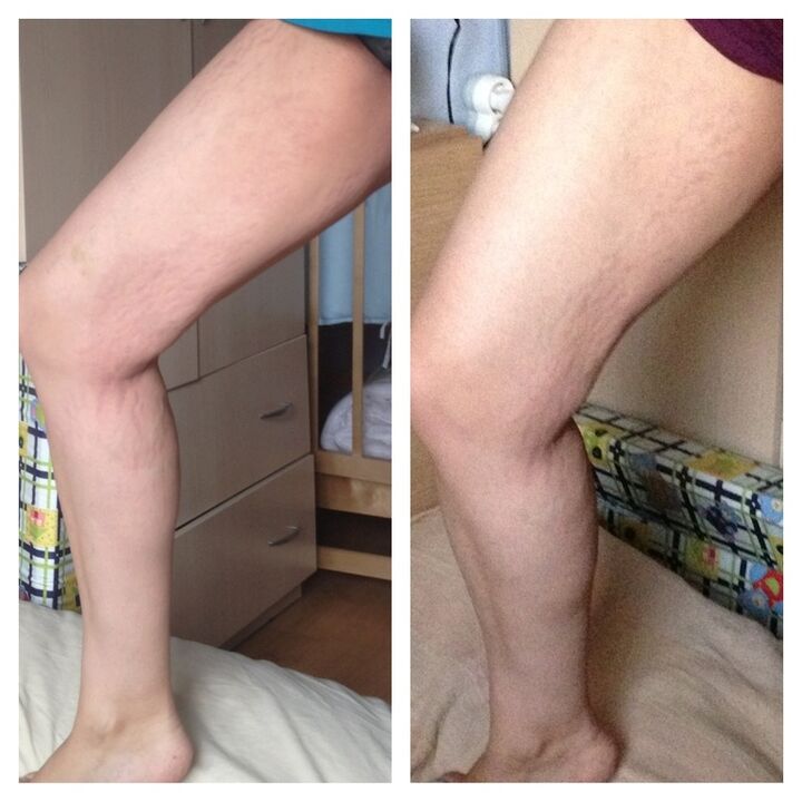 before and after knee